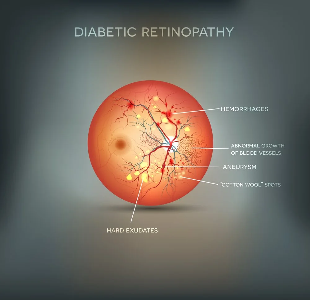 Diabetic Eye Exams and Disease Management