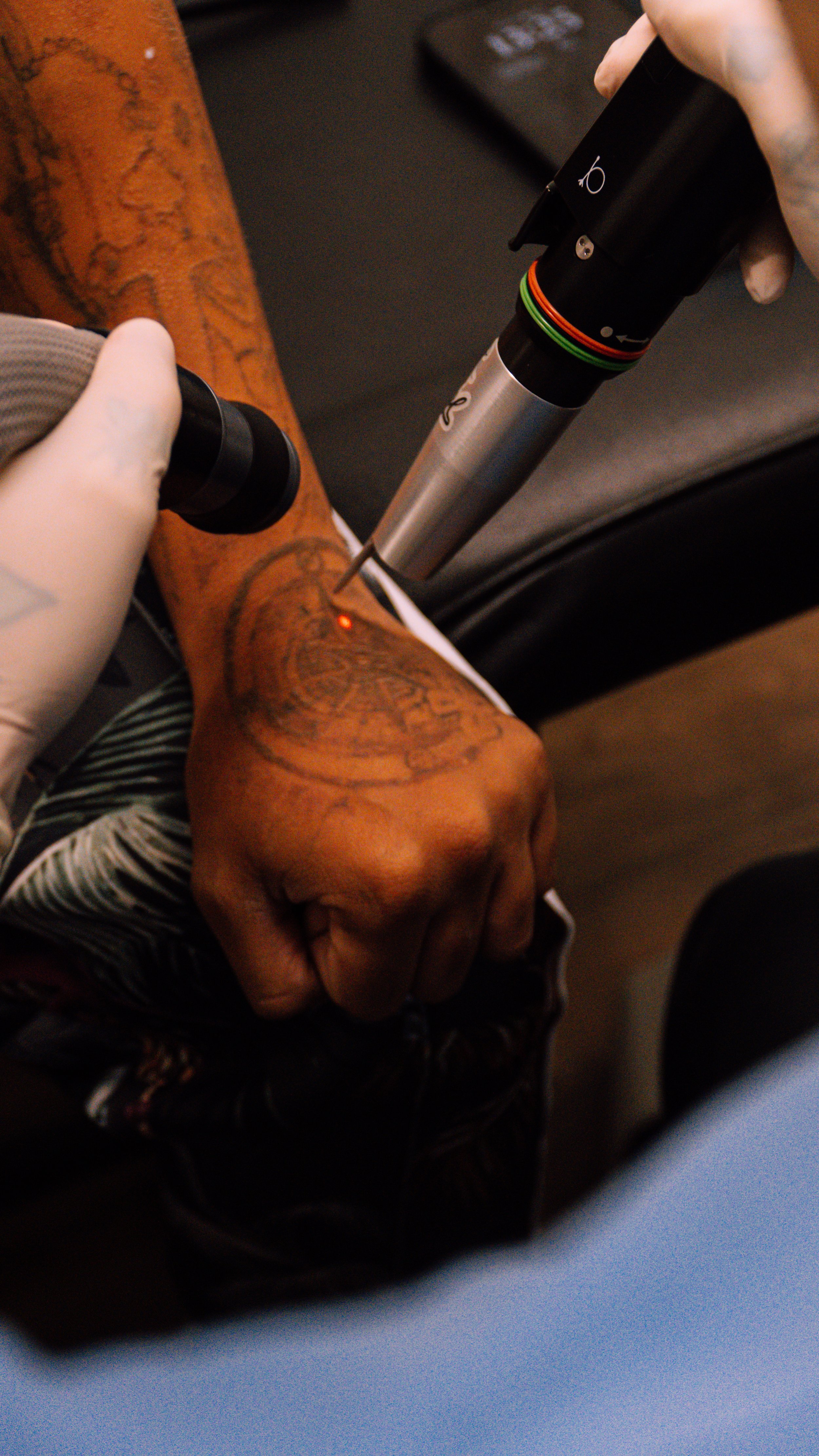 A person receiving laser tattoo removal on their forearm using a handheld laser device, with a technician wearing gloves.