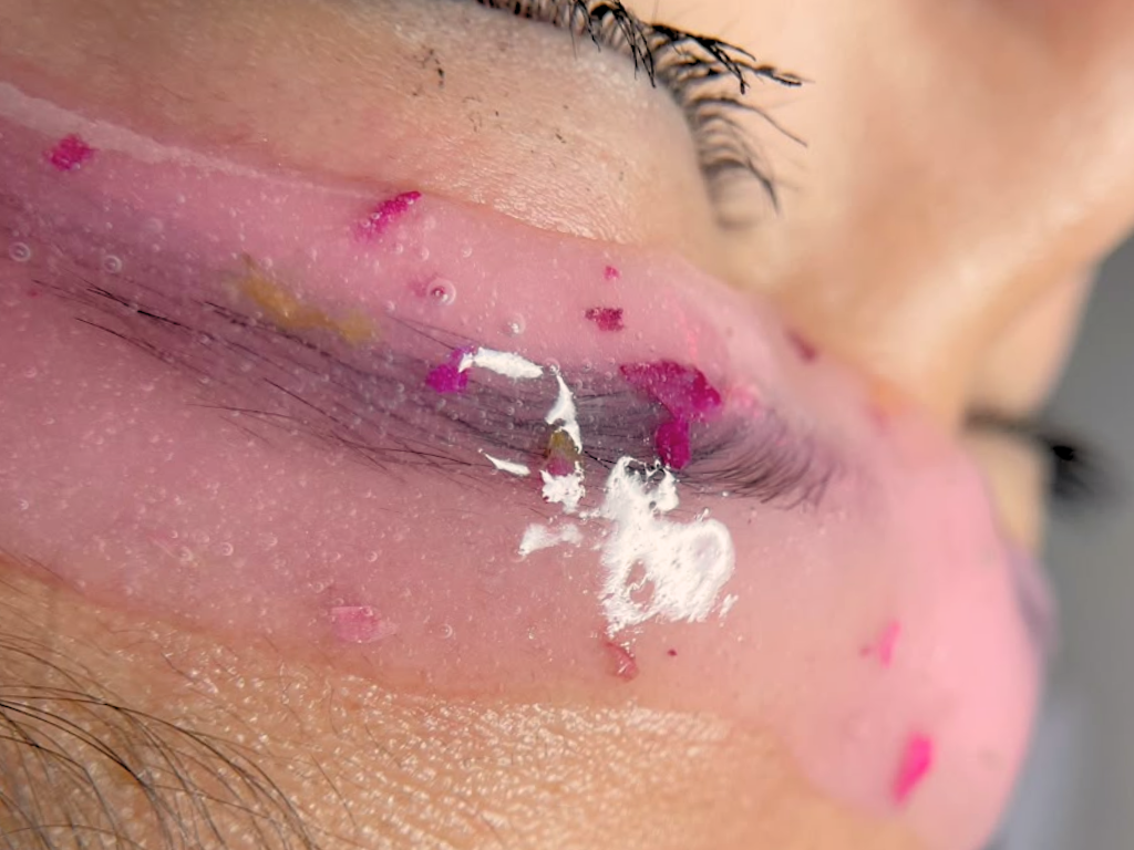 Close-up of a person's face with peeled skin and some white cream or ointment applied around the lips.