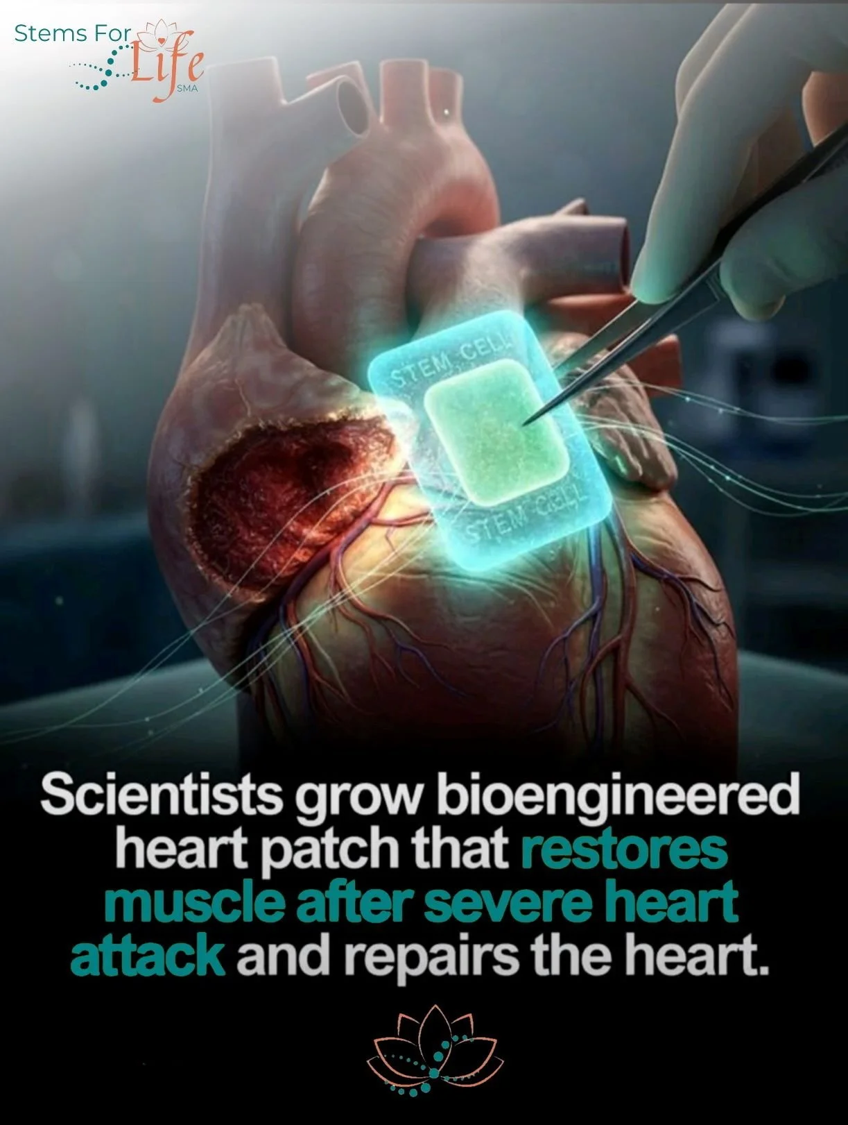 heart recovery with stem cell therapy