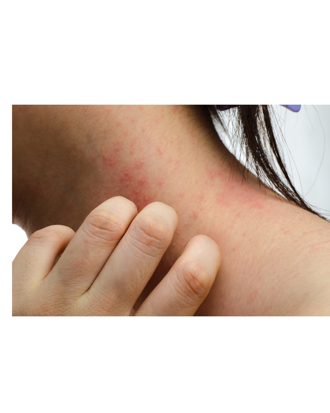 Eczema: Why It Happens, What Triggers Flares, and How to Treat It
