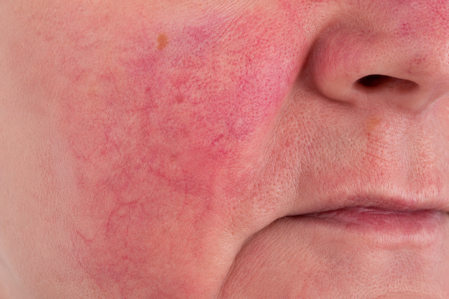 Close-up of persistent facial redness and visible blood vessels on the cheek and nose consistent with rosacea.