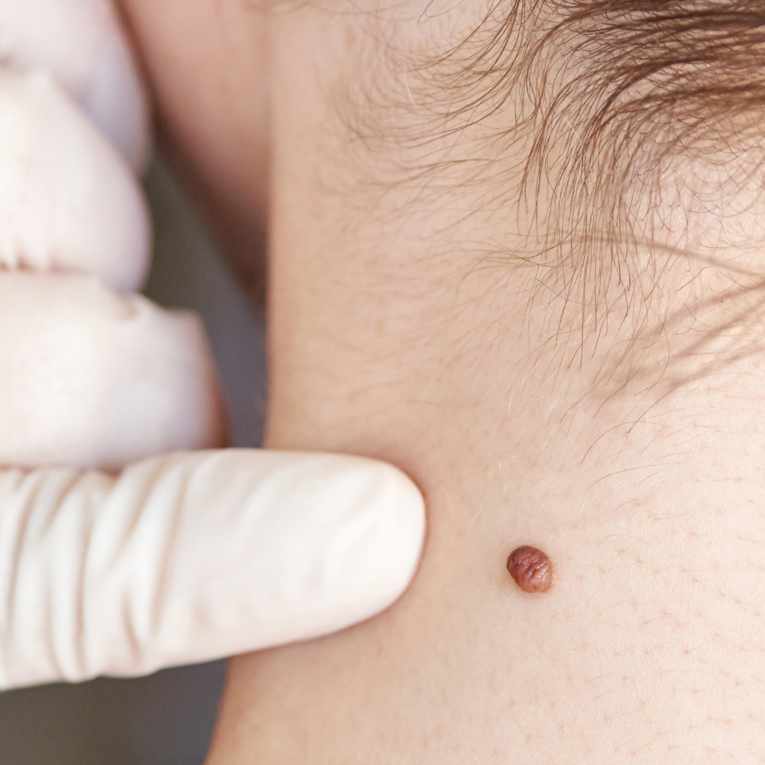 Close-up of a person's skin with a mole being examined by a gloved finger.