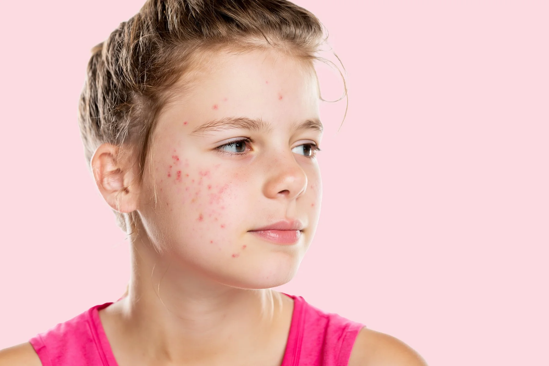Close-up of a young girl with light brown hair wearing a pink sleeveless top and showing facial acne against a pink background.