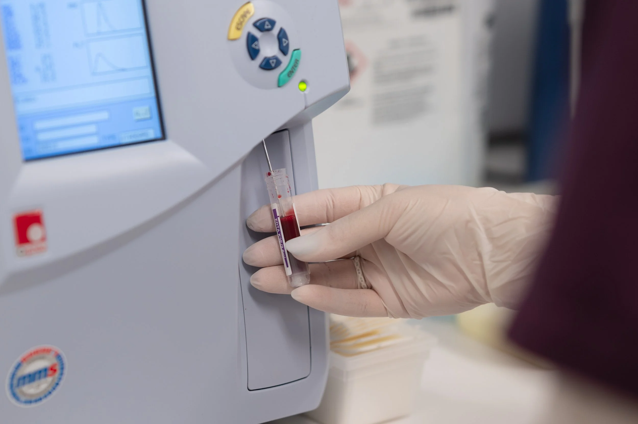 Eine Person trägt Einweghandschuhe und entnimmt eine Blutprobe mit einer Pipette aus einem Teströhrchen.