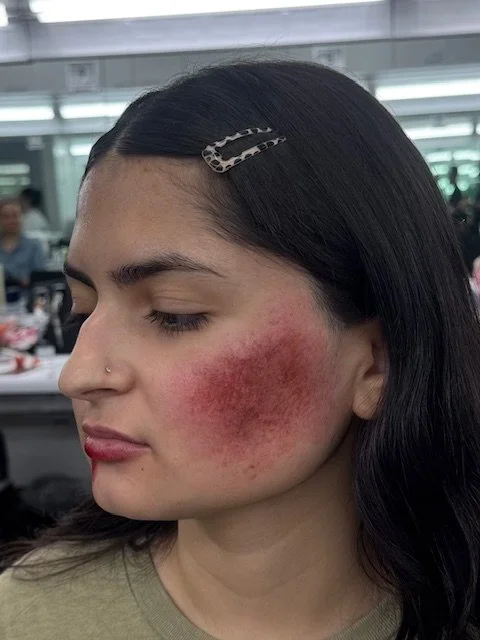 biance face bruise.jpg