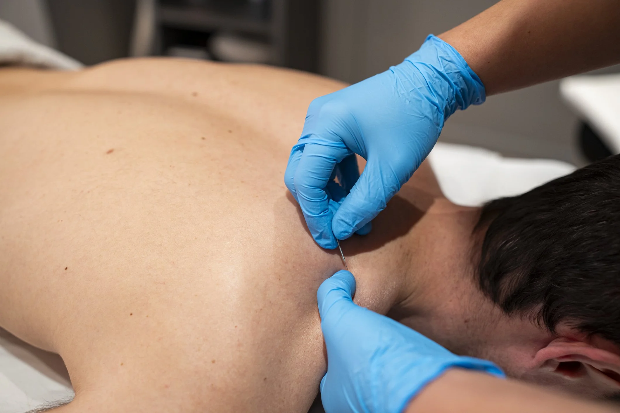 A person receiving dry needling in their shoulder from a healthcare professional wearing blue gloves.