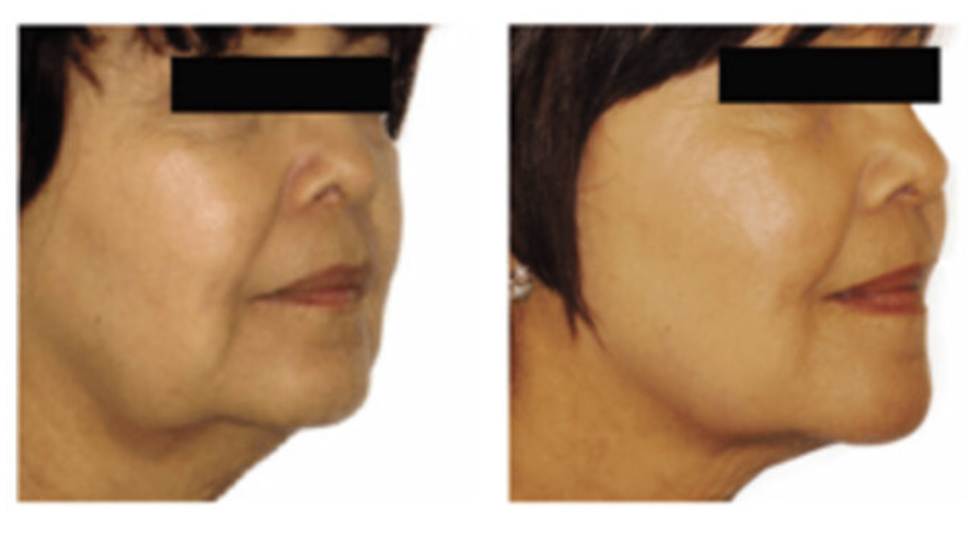 Comparison of a woman's face before and after a cosmetic treatment, showing improved skin firmness and reduced sagging.