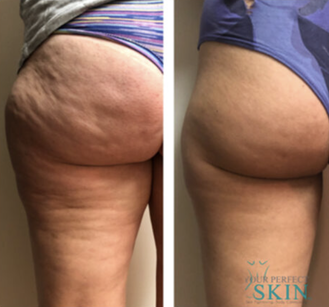 Comparison of a person's buttocks and thighs before and after skin treatment, showing reduced cellulite and firmer skin.