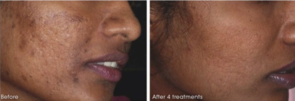 Close-up side profile of a woman's face showing improved skin texture after 4 treatments, with visible reduction in acne scars and smoother complexion.