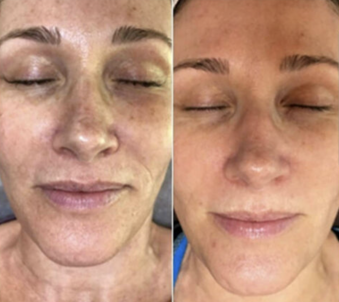 Side-by-side comparison of a woman's face before and after skincare treatment, showing improved skin clarity and texture on the right.