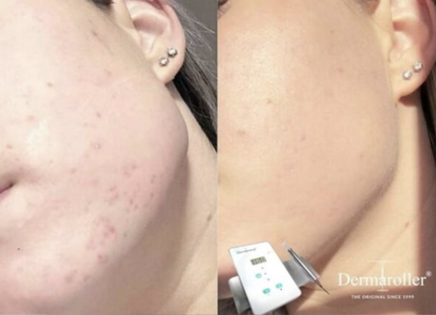 Comparison of a person's cheek before and after skincare treatment showing significant reduction in acne scars.
