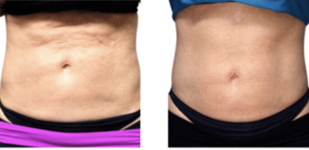 Comparison of a person's abdominal area showing a reduction in fat or skin of the stomach, likely illustrating before and after results of a weight loss or body contouring process.