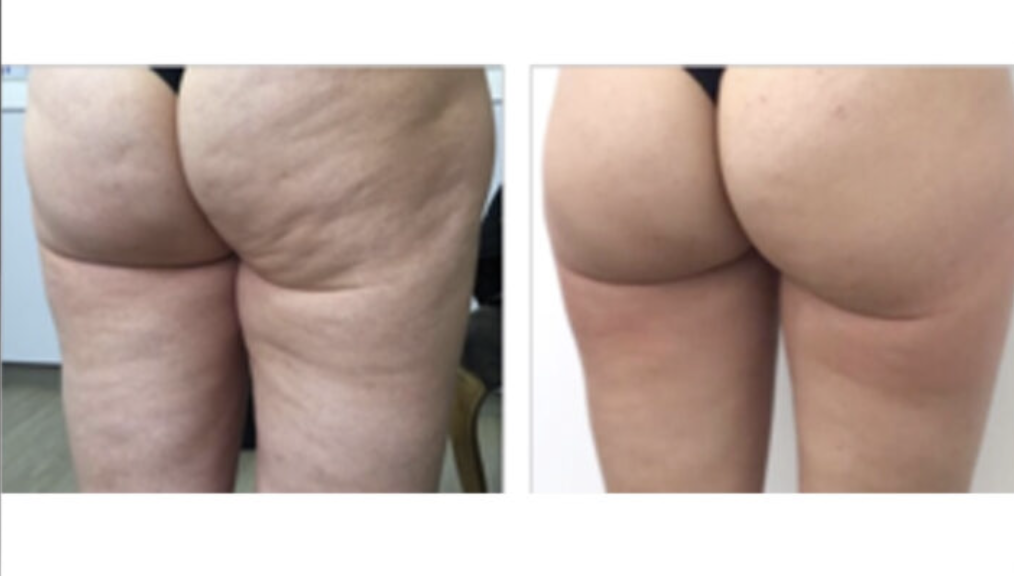 Comparison of two side-by-side photos showing the back view of a person in black underwear, highlighting the reduction in skin texture and cellulite on the buttocks and thighs in the second image.