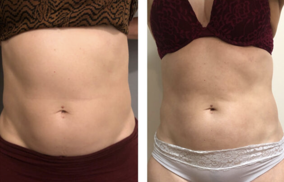 Comparison of a woman's midsection before and after weight loss or body transformation. The left shows a less toned abdomen, and the right shows a more toned and slimmer waist with visible muscle tone.