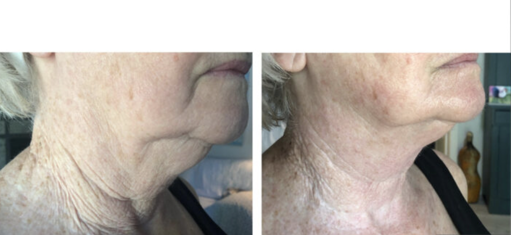 Comparison of an elderly woman's neck and chin area before and after skin treatment, showing smoother skin and reduced wrinkles in the second image.