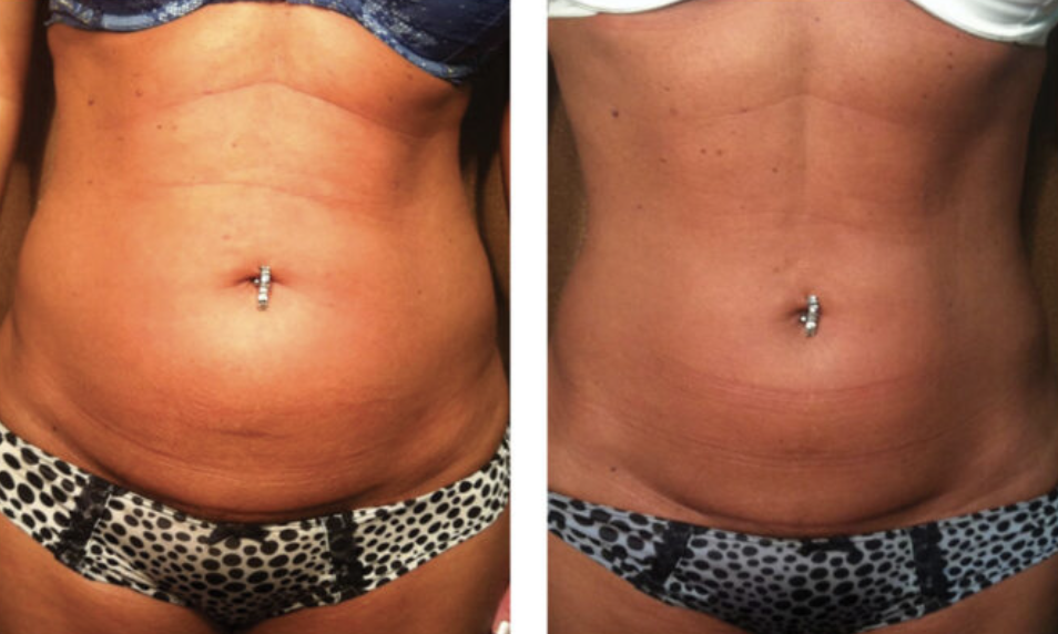 Comparison of a person's abdomen before and after visible skin tightening or weight loss, with a navel piercing, wearing polka dot patterned underwear.