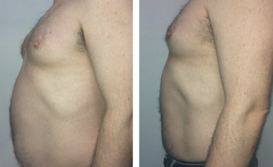 Comparison photo showing a man's torso before and after weight loss or fitness transformation, with the left side displaying a larger abdomen and the right side showing a slimmer profile.