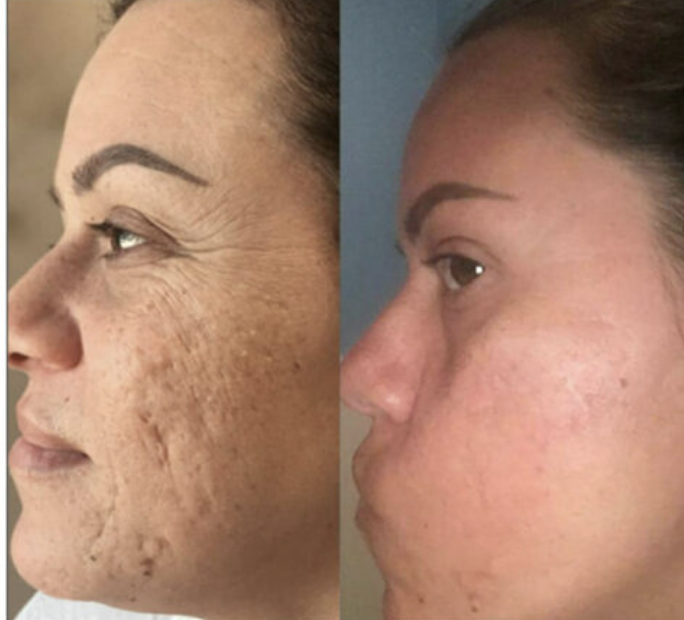 Side-by-side comparison of a woman's face showing significant skin improvement; left side shows hyperpigmentation and acne scars, right side shows clearer, smoother skin.