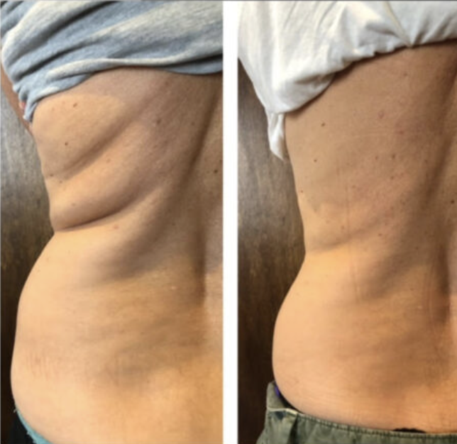 Comparison of a person's side torso before and after weight loss or body transformation, showing reduced fat and a more toned appearance.