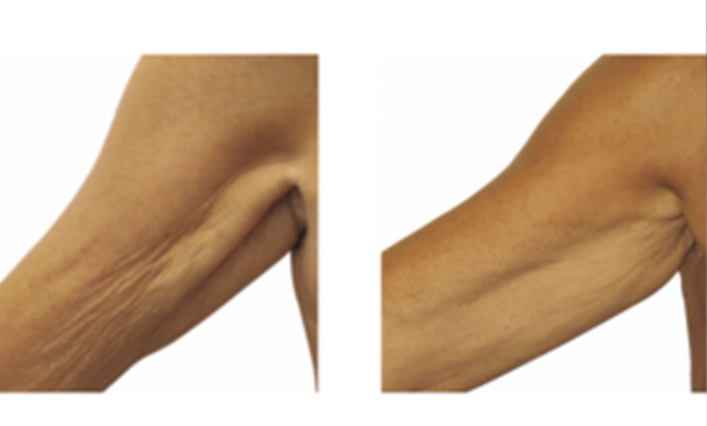 Comparison of an underarm with loose, sagging skin on the left and a more toned, tightened underarm on the right.