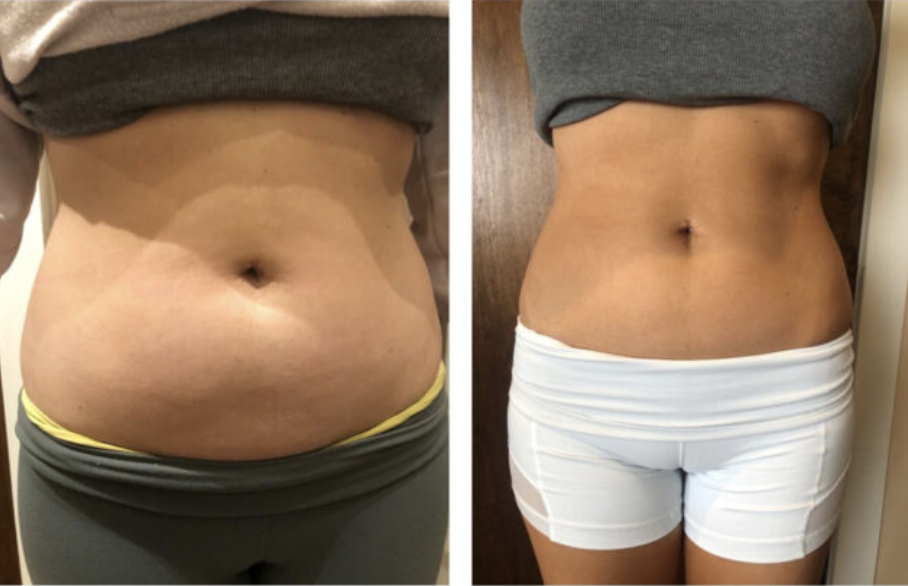 Comparison of a woman's abdomen before and after weight loss or body transformation, showing a flatter stomach on the right.