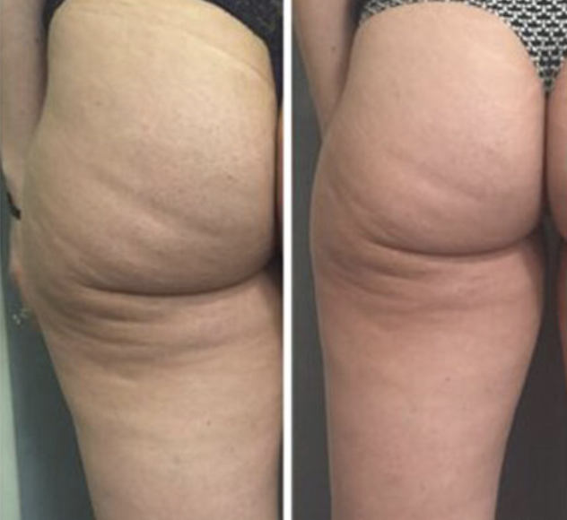 Comparison of thighs and buttocks before and after treatment showing reduced cellulite and smoother skin.