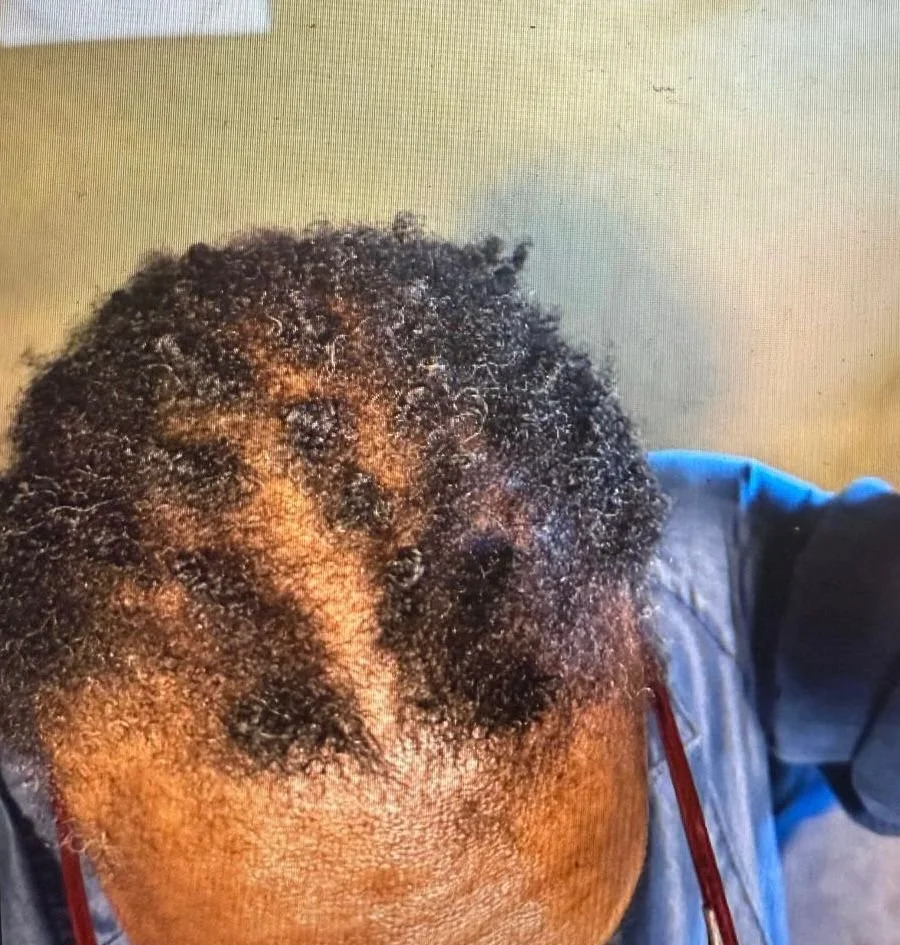 Close-up of client’s scalp with thinning hair at the crown and hairline during trichology hair loss consultation in Oakland, California. Top view of client’s vertex and crown area with visible hair thinning documented for hair loss assessment.