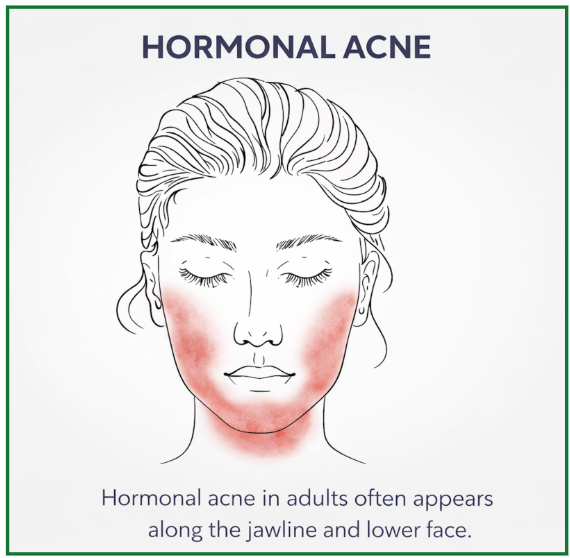 Adult Acne: Causes, Treatments, and Why It Happens in Your 20s, 30s, and Beyond