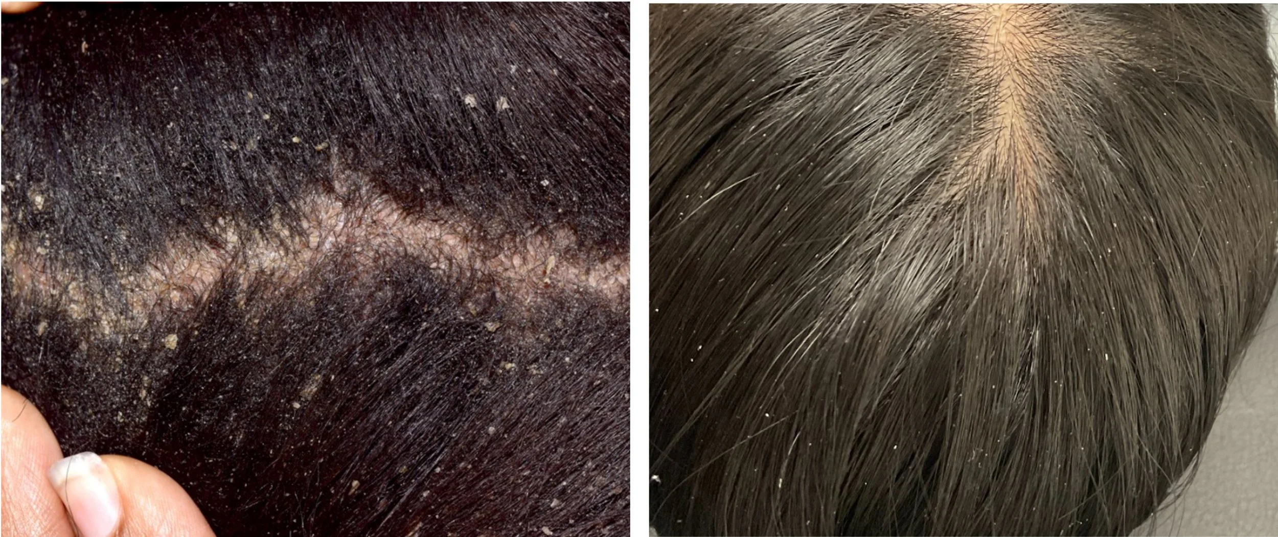 Dandruff vs. Dry Scalp: How to Tell the Difference
