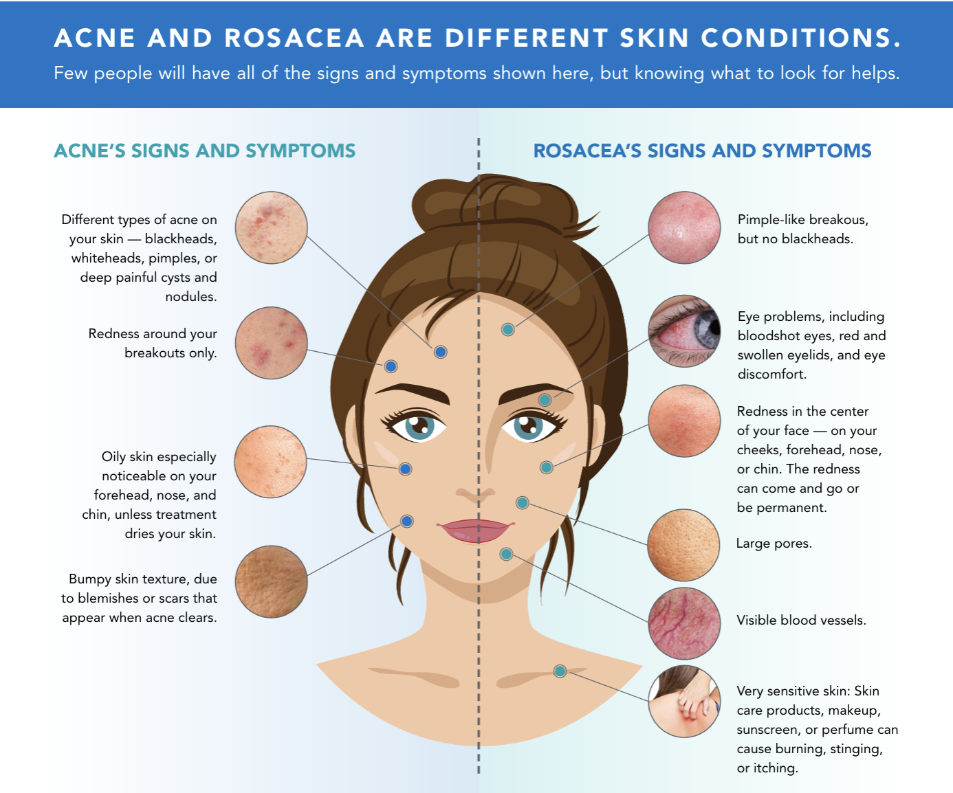 Rosacea vs Acne: How to Tell the Difference