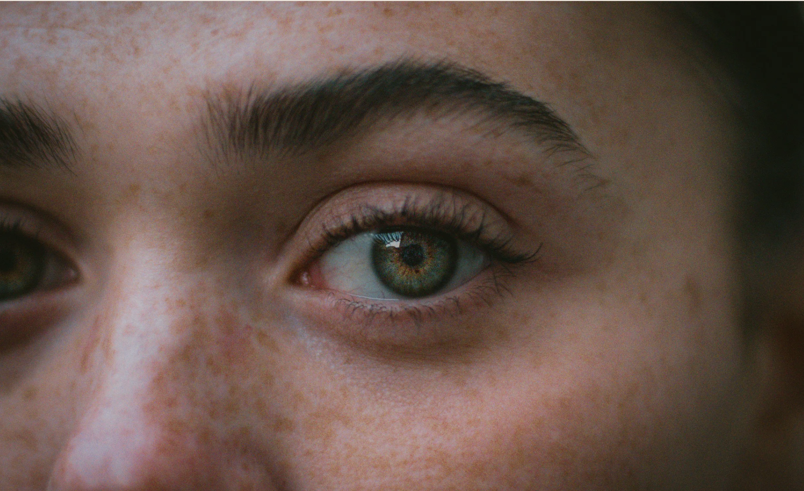 Melasma: Causes, Treatment, and Why It’s So Difficult to Treat