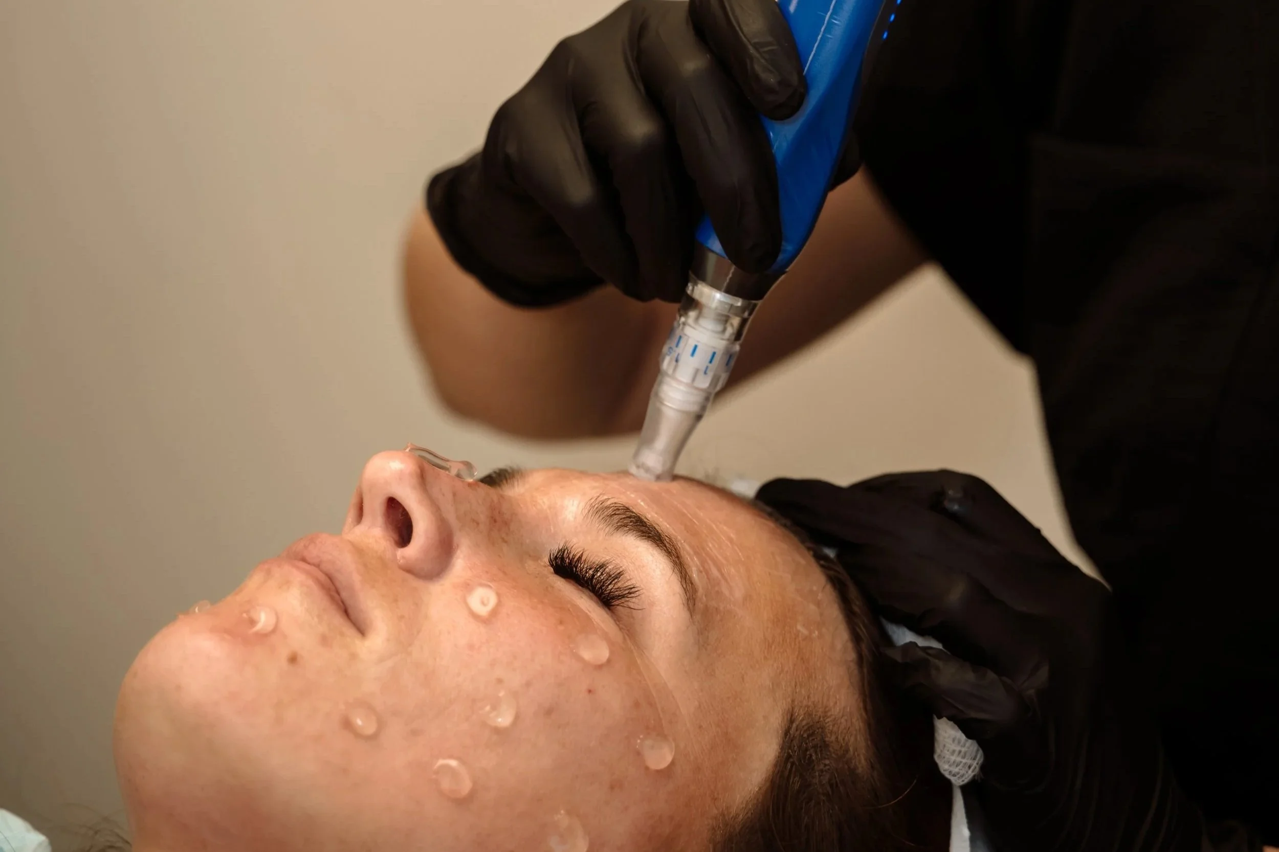 The Best Microneedling in Scottsburg, IN