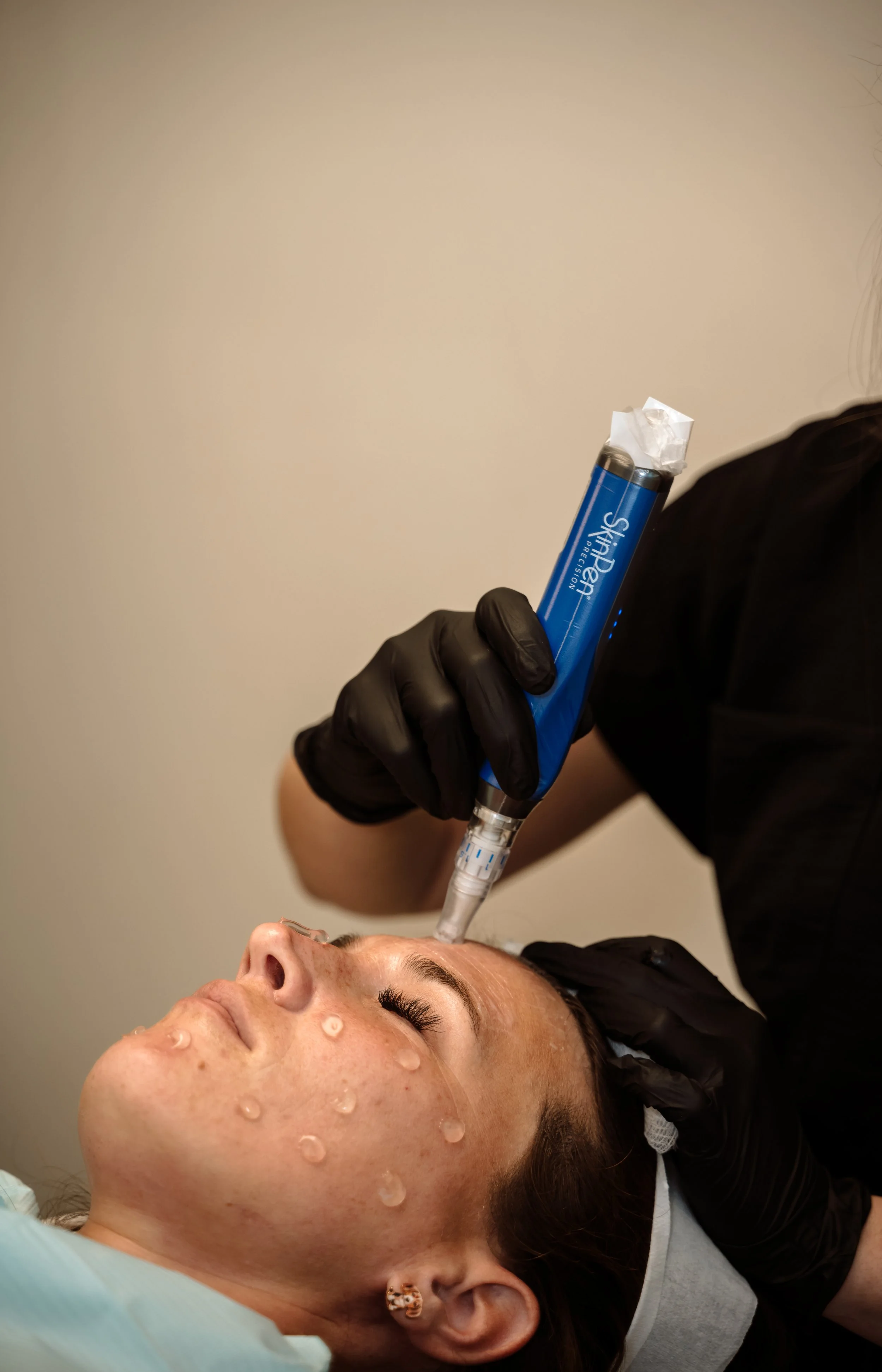 Microneedling treatment