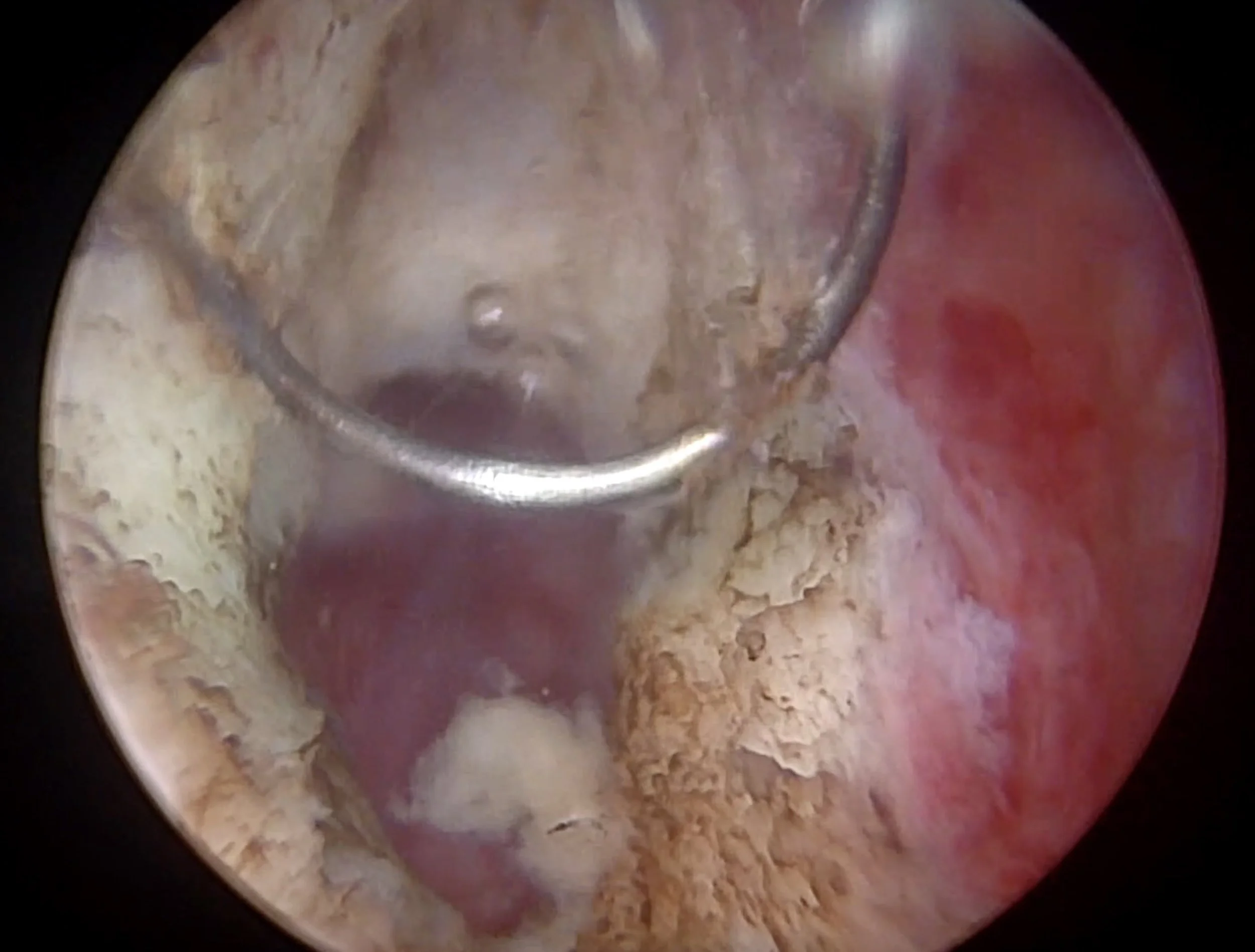 Transurethral resection of ejaculatory duct