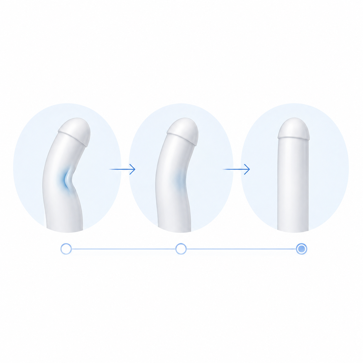 Peyronie's Treatment Explorer