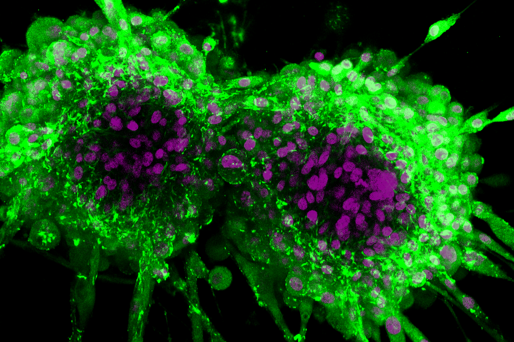 Glioblastoma cells in 3D hydrogels