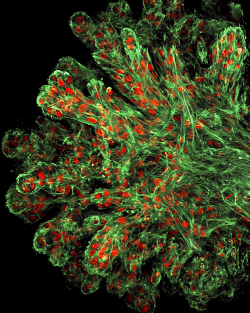 Neuro-oncology GBM spheroid microscopy