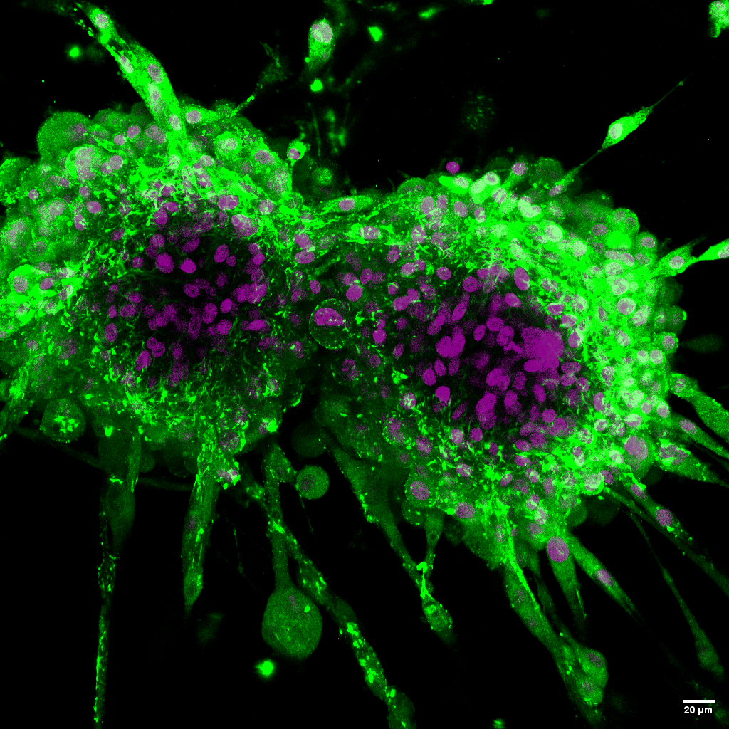 Brain#tumors remain among the most challenging cancers to treat, with#glioblastoma (GBM).Captured via hashtag#fluorescence microscopy, the image shows:
🟢 Collagen: a key component of ECM
🟣 Nuclei