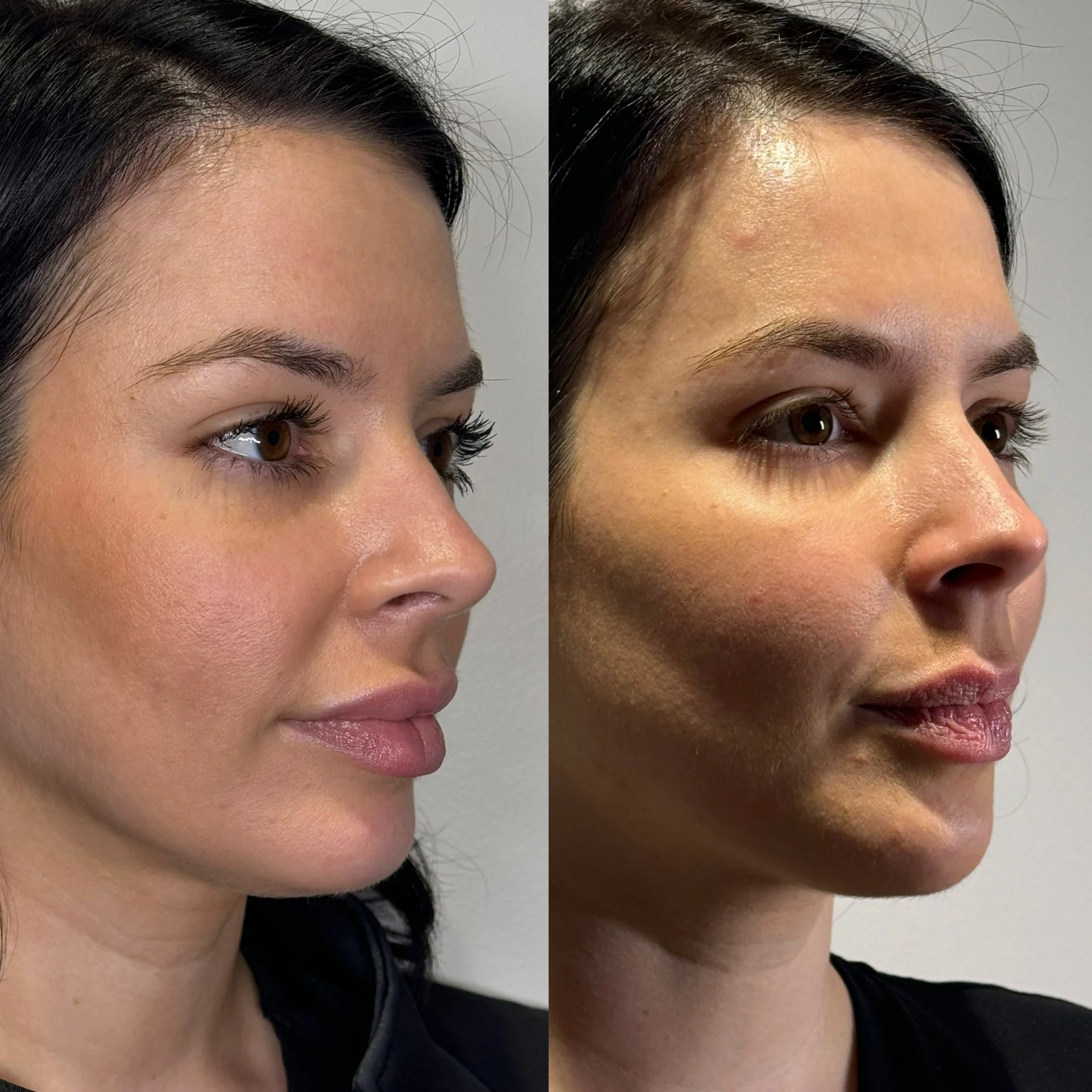 Side-by-side comparison of a woman's face profile balancing, cheek filler, lip filler, and chin filler with ha filler.