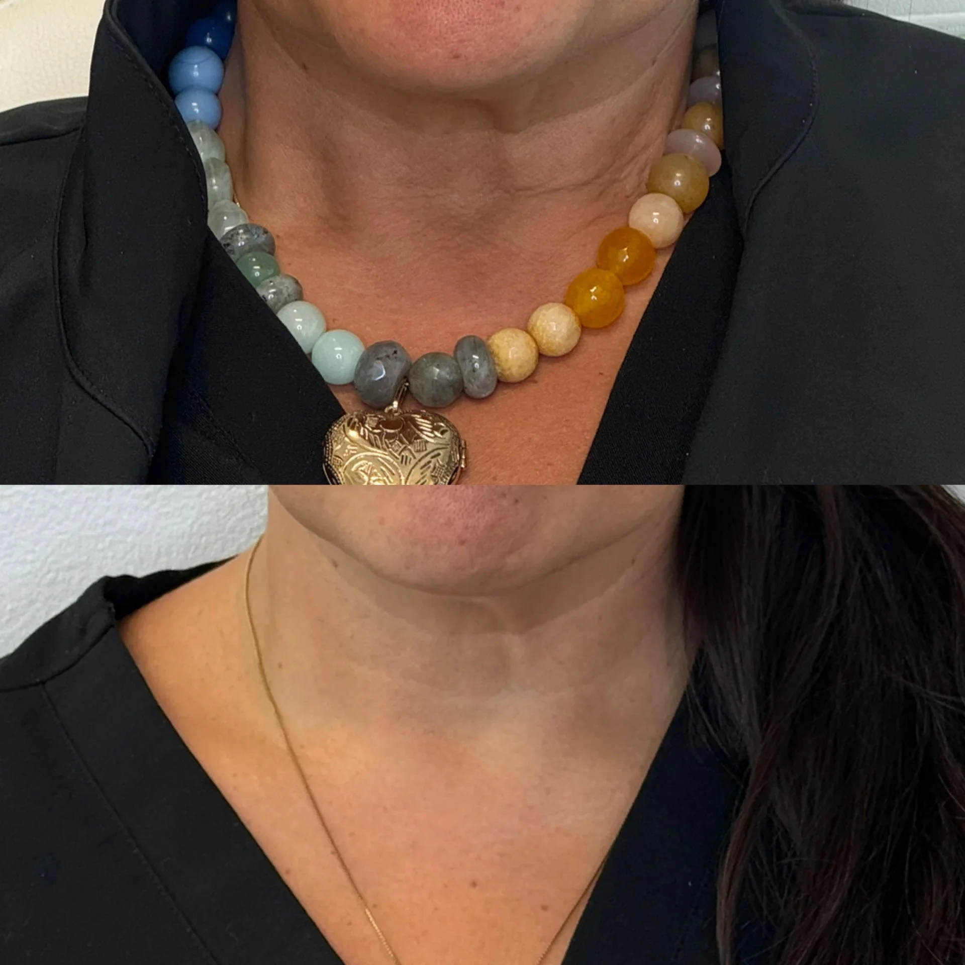 Before and after photos of a woman's neck and collarbone area, showing a reduction in the appearance of skin sagging or aging.