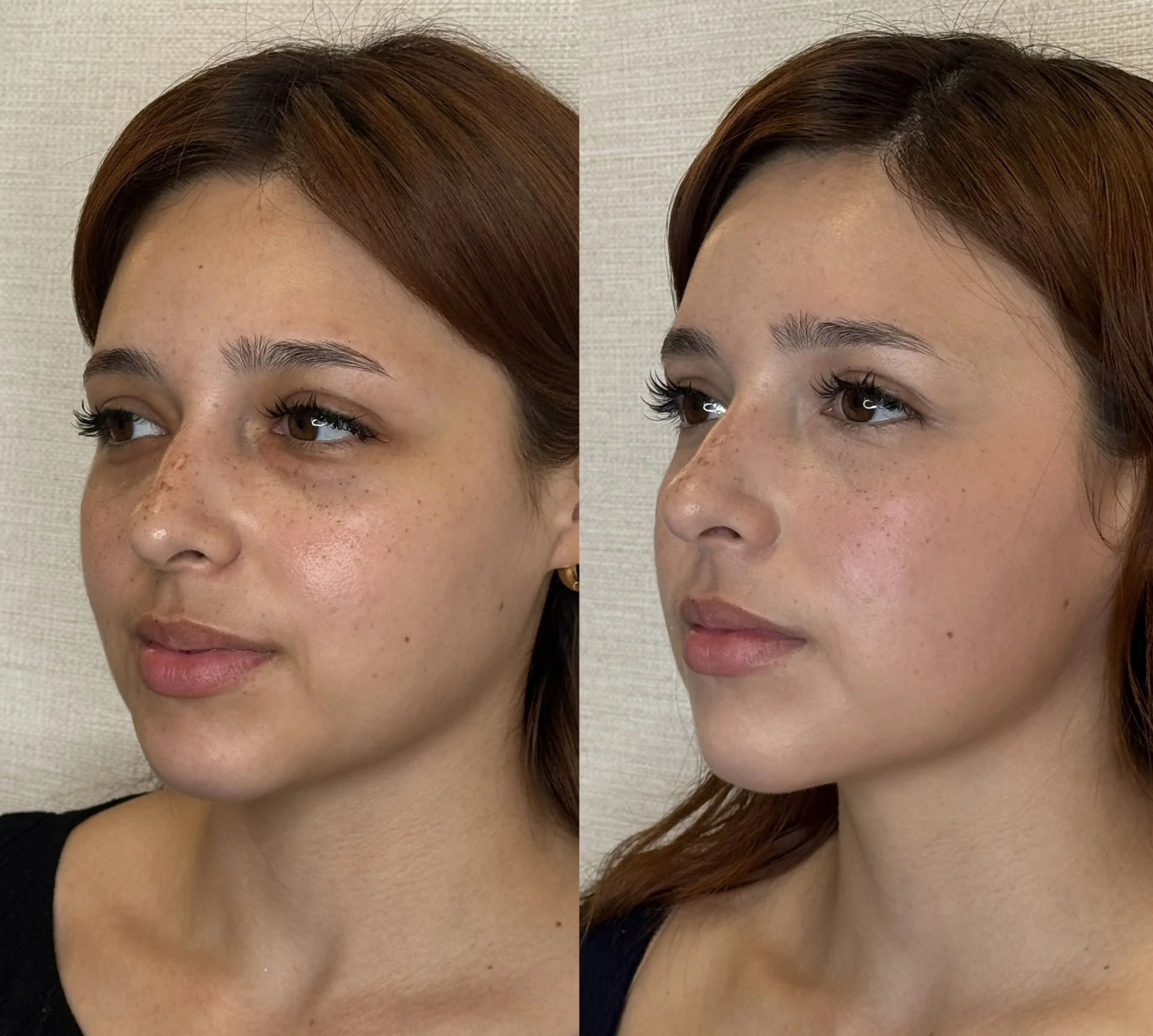 Ethnic woman with undereye treatment and chin support. 