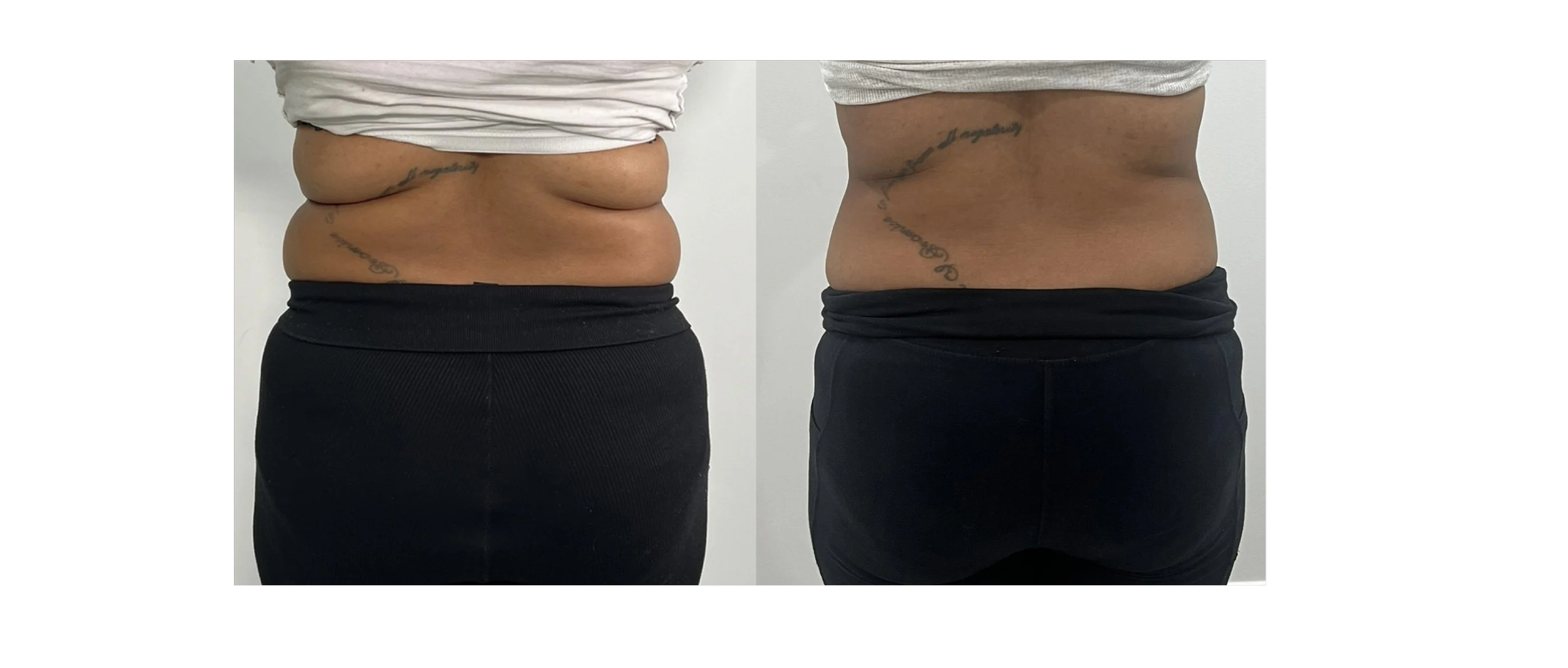 Side-by-side comparison of a person's lower back and waist before and after a weight loss or body transformation. The left image shows more fat and skin folds, while the right image shows a slimmer waistline.