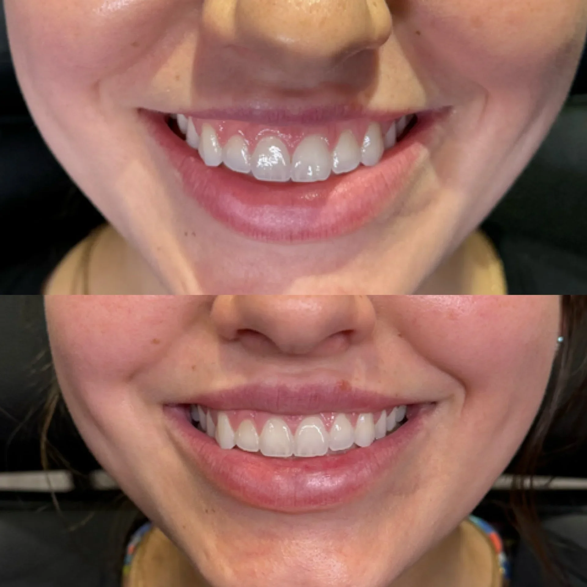 Close-up of a person's smiling mouth before and after dental treatment, showing improved teeth appearance.