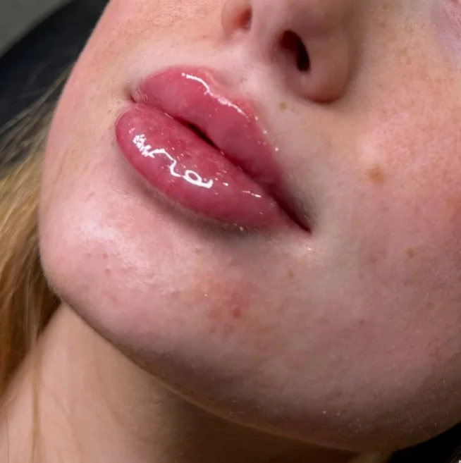Natural lip filler like Kylie Jenner.
