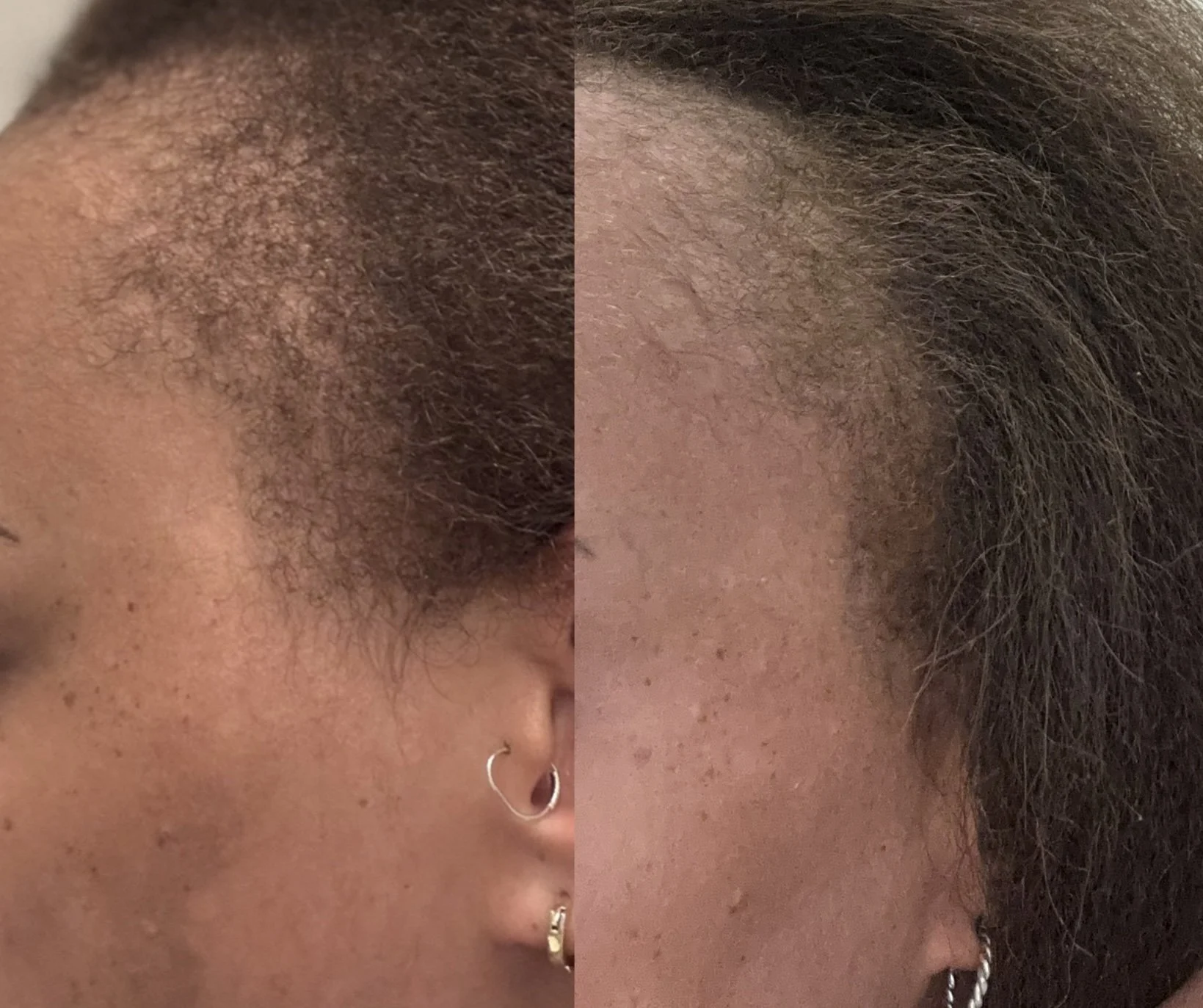 Hair regeneration before and after with microneedling and prf hair restoration.