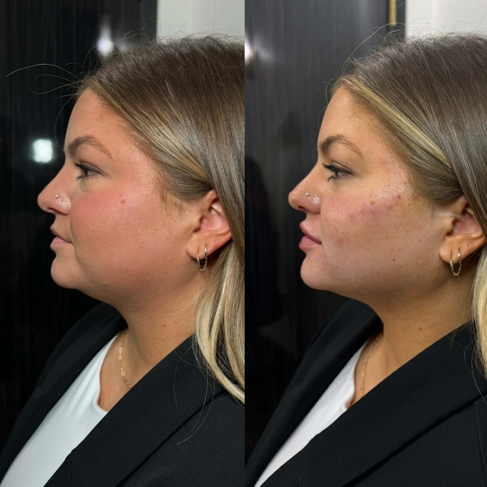 Facial slimming and submental, double chin, chin fat removal or decrease with the ha filler.  