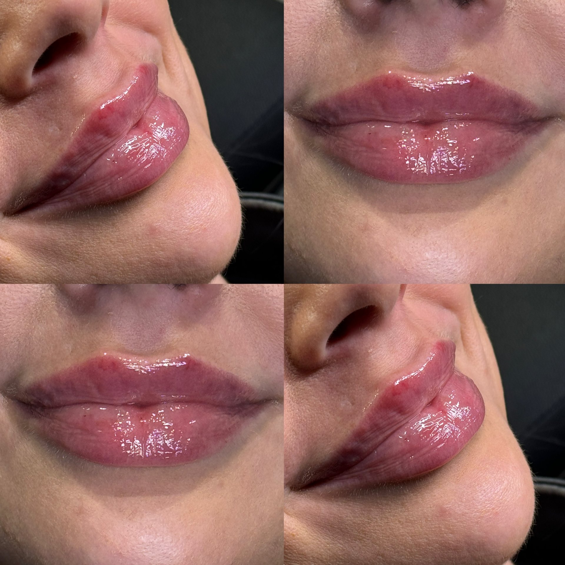 Full lips, lip shaping, and lip structure with ha filler.