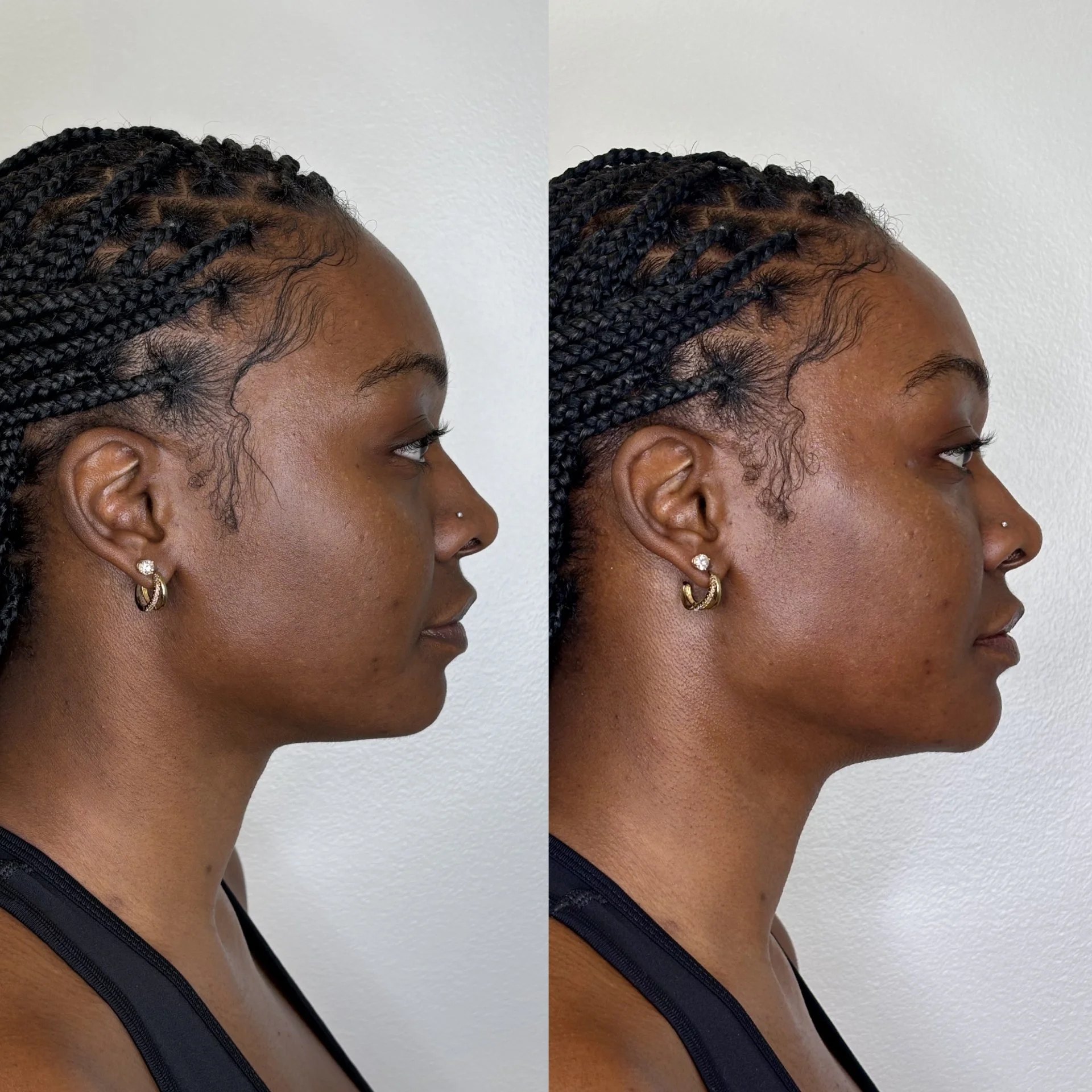 Ha filler of woman in 20s with jawline filler and chin filler to enhance side profile.