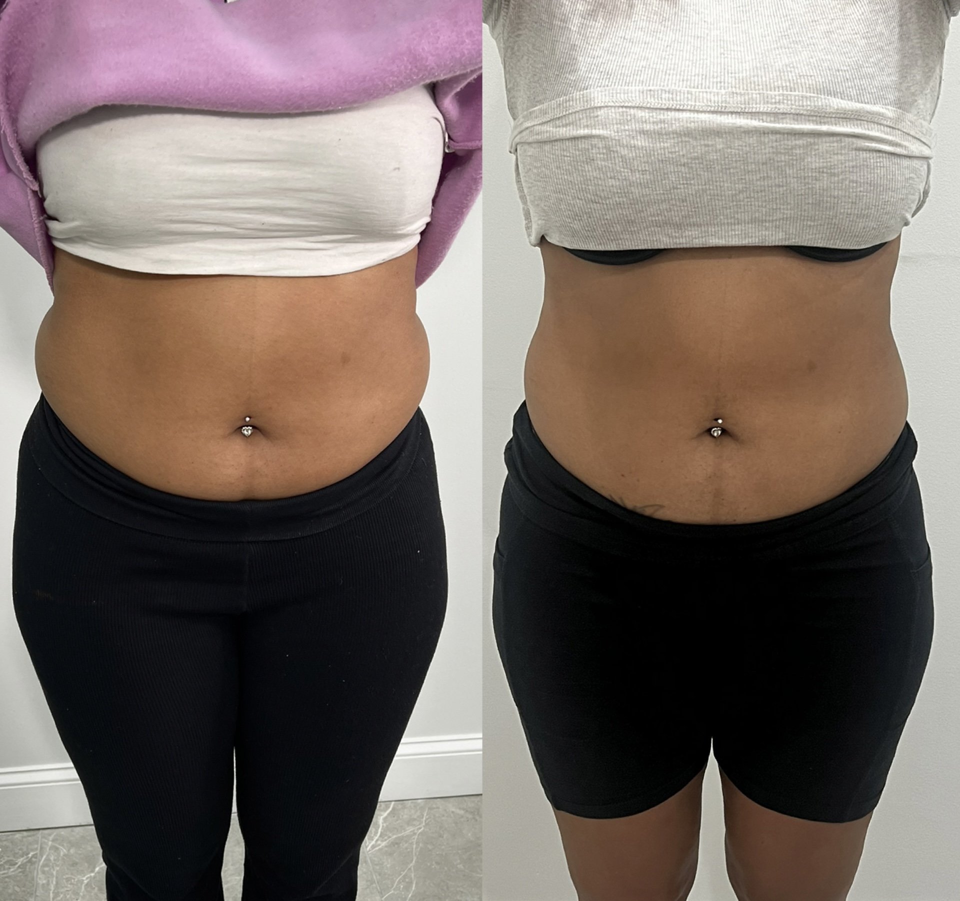 Side-by-side comparison of a woman's abdominal area before and after fitness or weight loss progress